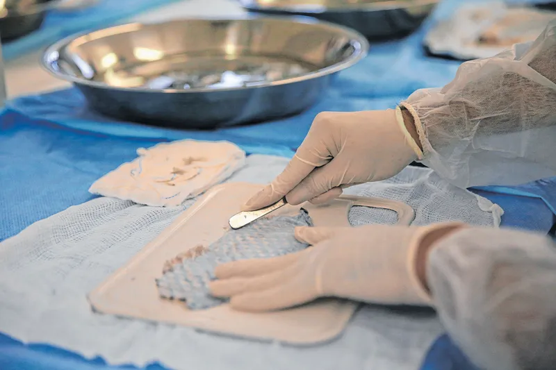 A pele da tilápia é usada como curativo biológico e temporário no tratamento de queimaduras
