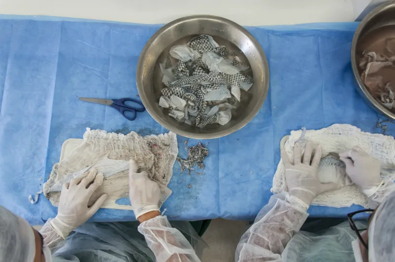 Pele de tilápia é usada em reconstrução vaginal após cirurgia de mudança de sexo