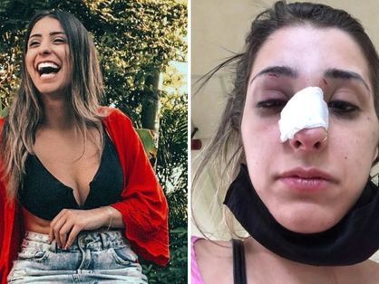 Esta imagem mostra a antes de depois da jovem Gabriela Casellato que foi agredida pelo ex-namorando em SP e ficou com o rosto deformado