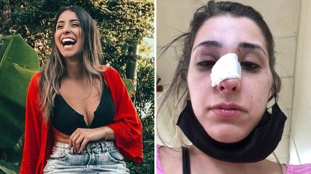 Esta imagem mostra a antes de depois da jovem Gabriela Casellato que foi agredida pelo ex-namorando em SP e ficou com o rosto deformado