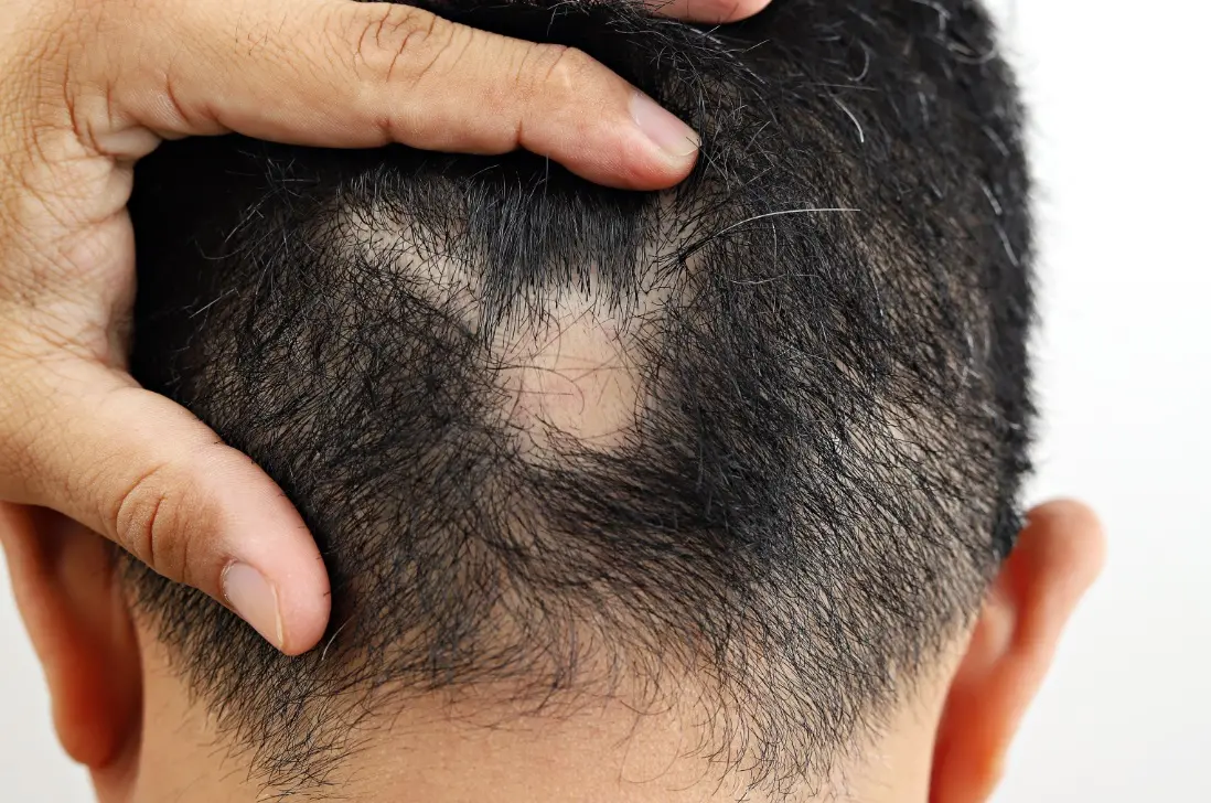 Segundo a Organização Mundial da Saúde (OMS), o problema atinge metade dos homens com até 50 anos.