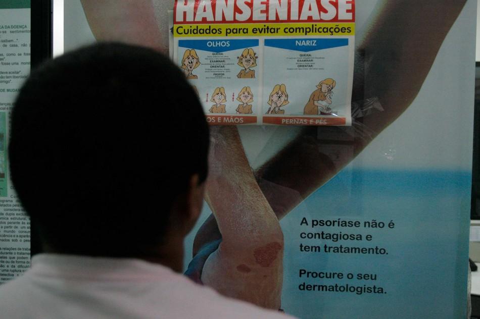 Médicos consideram número de casos de hanseníase no Brasil