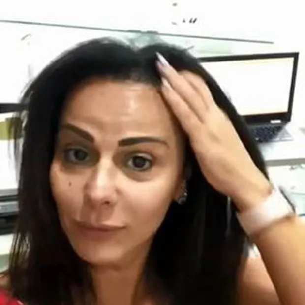 Viviane teve alopecia após colocar tranças no cabelo em 2018