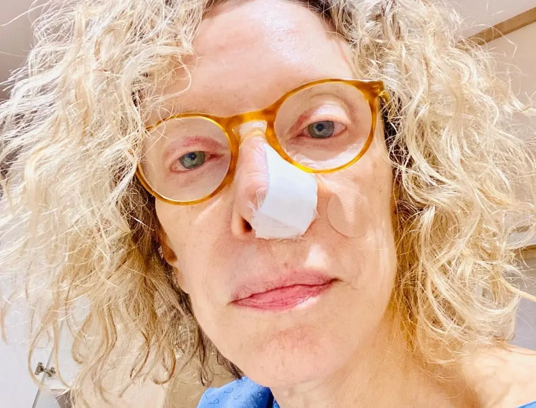 Marília Gabriela após cirurgia de retirada de câncer de pele