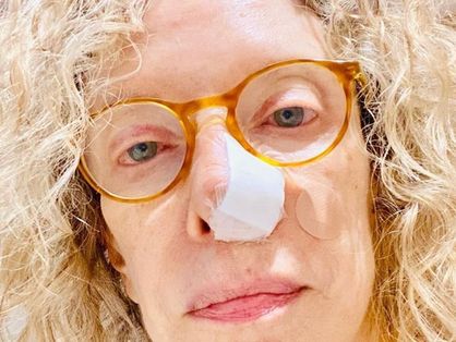 Jornalista Marília Gabriela, diagnosticada com carcinoma basocelular, com um curativo no nariz
