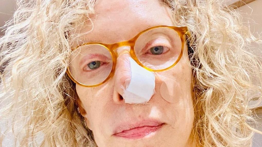 Jornalista Marília Gabriela, diagnosticada com carcinoma basocelular, com um curativo no nariz