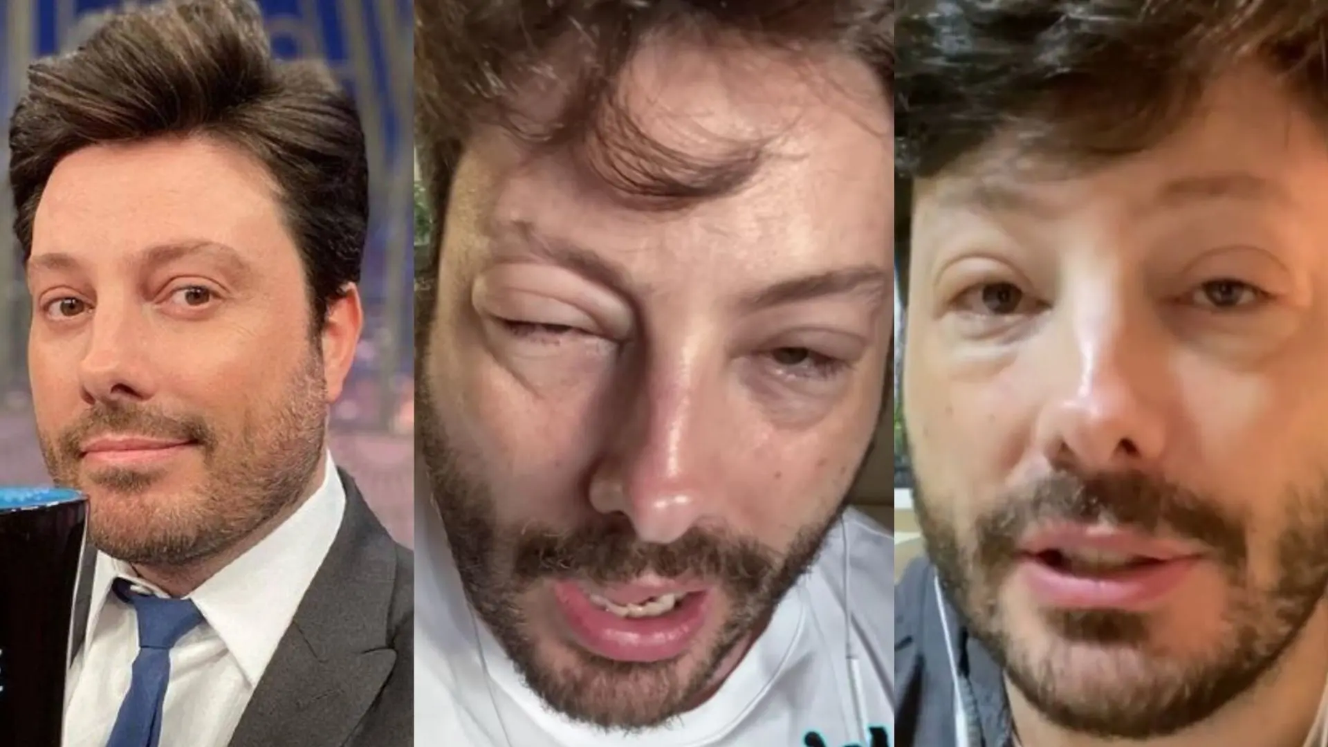 Danilo Gentili aparece com rosto deformado após alergia a medicamento