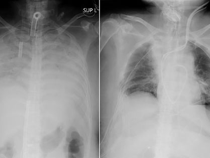 Radiografia com pulmões afetados pela Covid-19