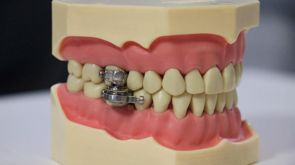 Dispositivo para perda de peso criado por pesquisadores da Nova Zelândia que usa ímãs para prender a mandíbula de um paciente