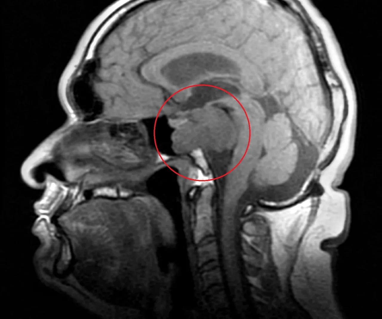Por ser uma doença rara, médicos ainda não sabem precisar a data de surgimento do tumor, podendo ter se desenvolvido desde a infância de Eberth