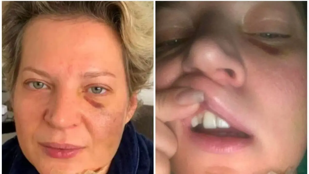 Joice Hasselmann com fraturas e hematomas no corpo