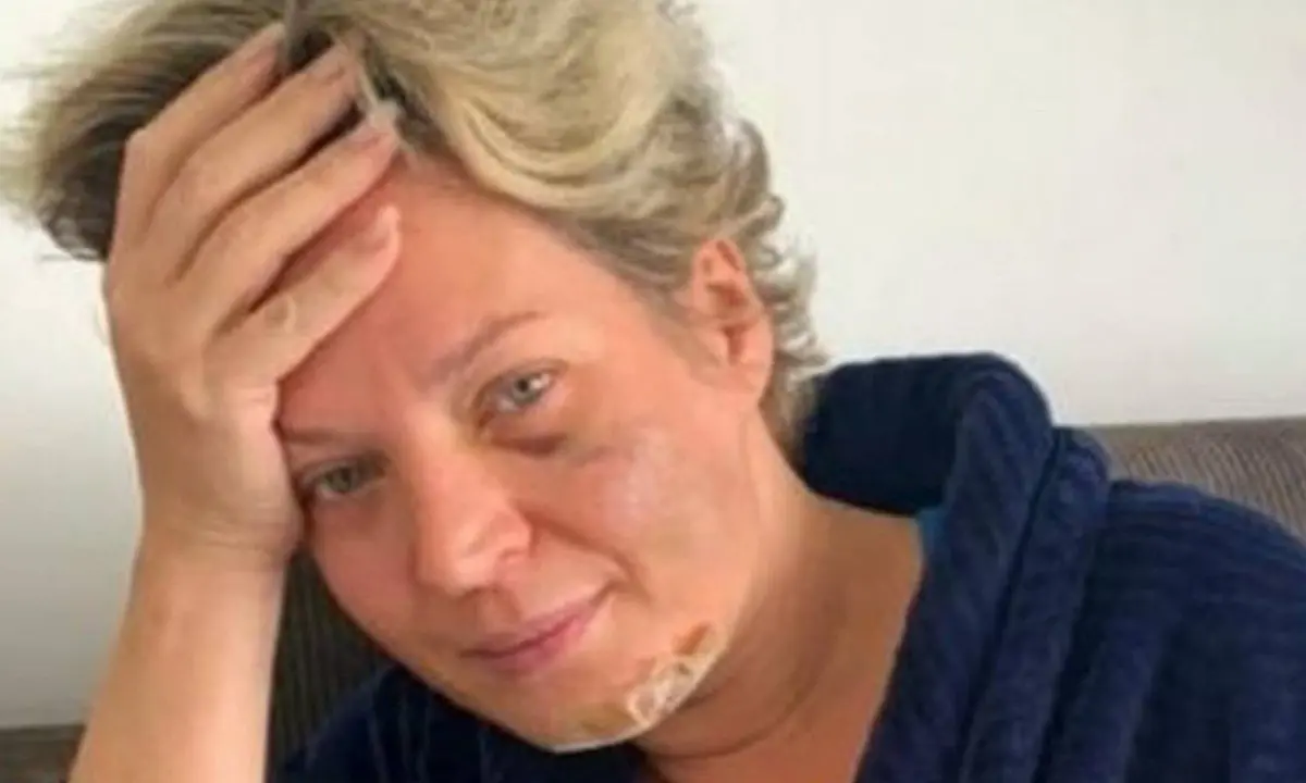 Deputada federal Joice Hasselmann revela fraturas pelo corpo