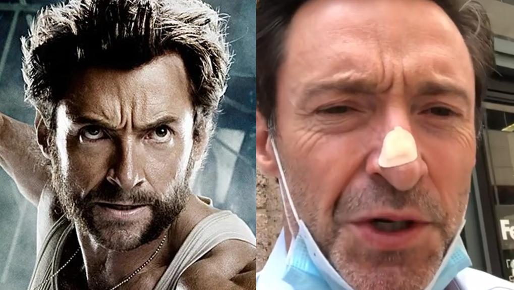 Ator de Wolverine já foi tratado de câncer de pele no nariz cinco vezes