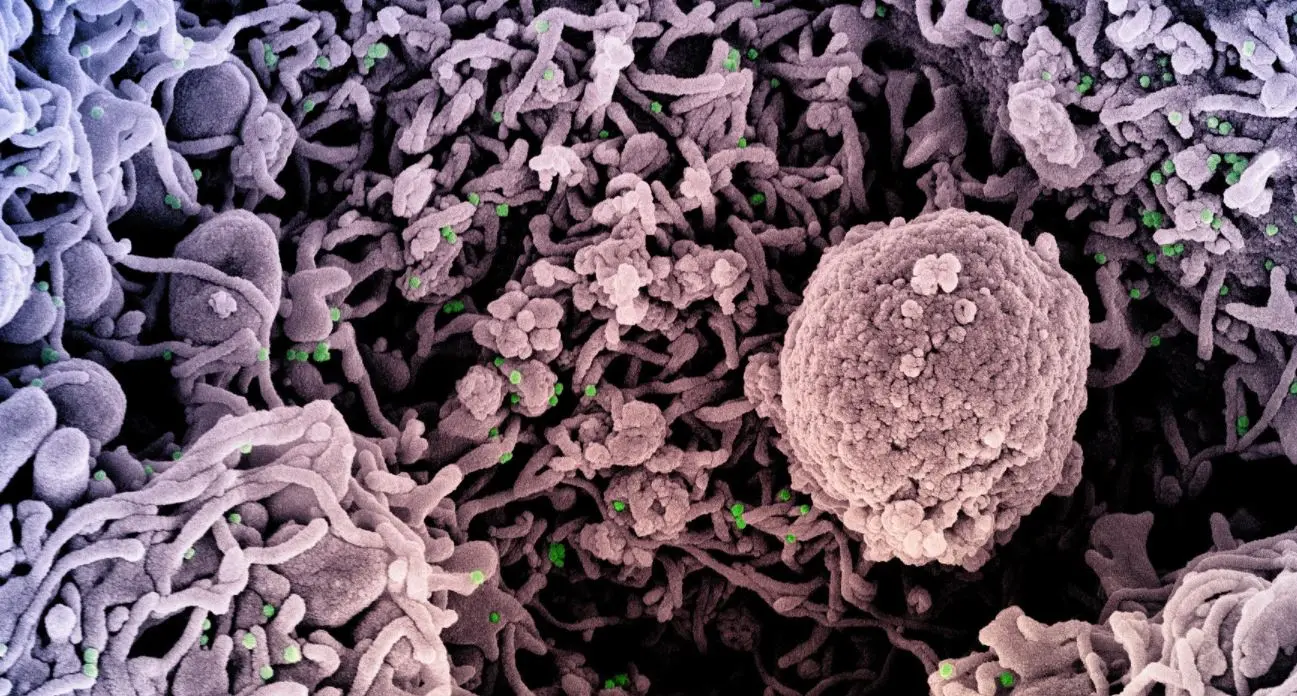 Células sendo atacadas por coronavírus, em verde