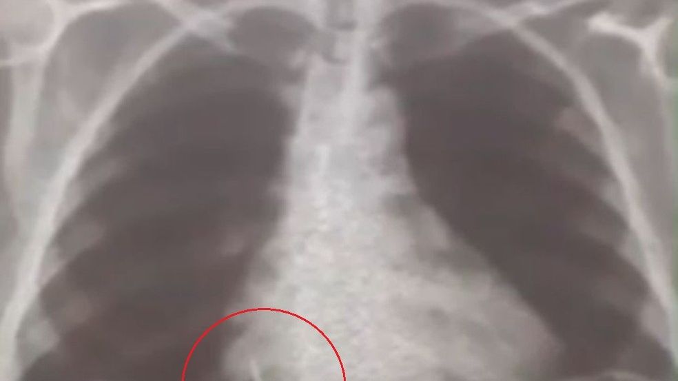 Raio X mostrando broca presa no pulmão de paciente do RN