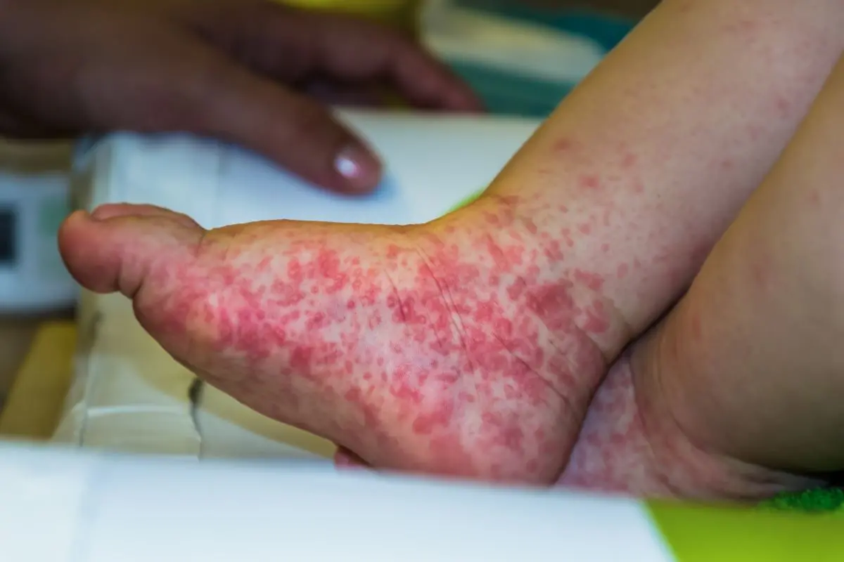 Lesões em pé de bebê decorrentes da doença mão-pé-boca