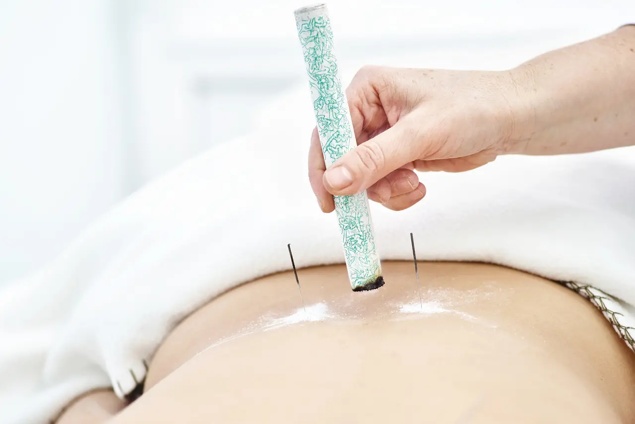 A moxaterapia é uma técnica que aquece pontos de acupuntura ou áreas do corpo a serem tratadas