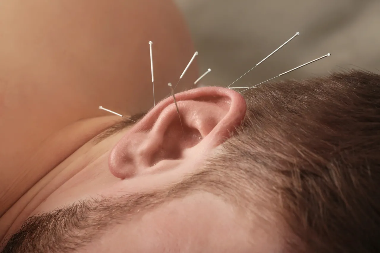 A auriculoterapia é uma modalidade da acupuntura