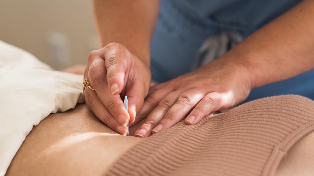 Imagem de uma agulha de acupuntura sendo colocada nas costas de uma mulher