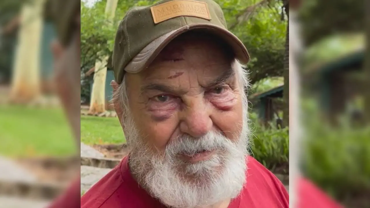 Lima Duarte com rosto machucado após acidente