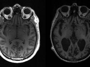 Imagem mostra cérebro saudável, à esquerda, e outro com alzheimer, à direita, com grandes áreas escuras