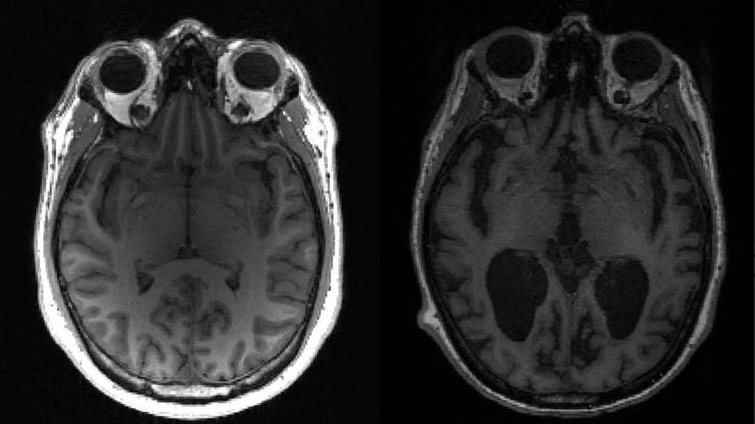 Imagem mostra cérebro saudável, à esquerda, e outro com alzheimer, à direita, com grandes áreas escuras