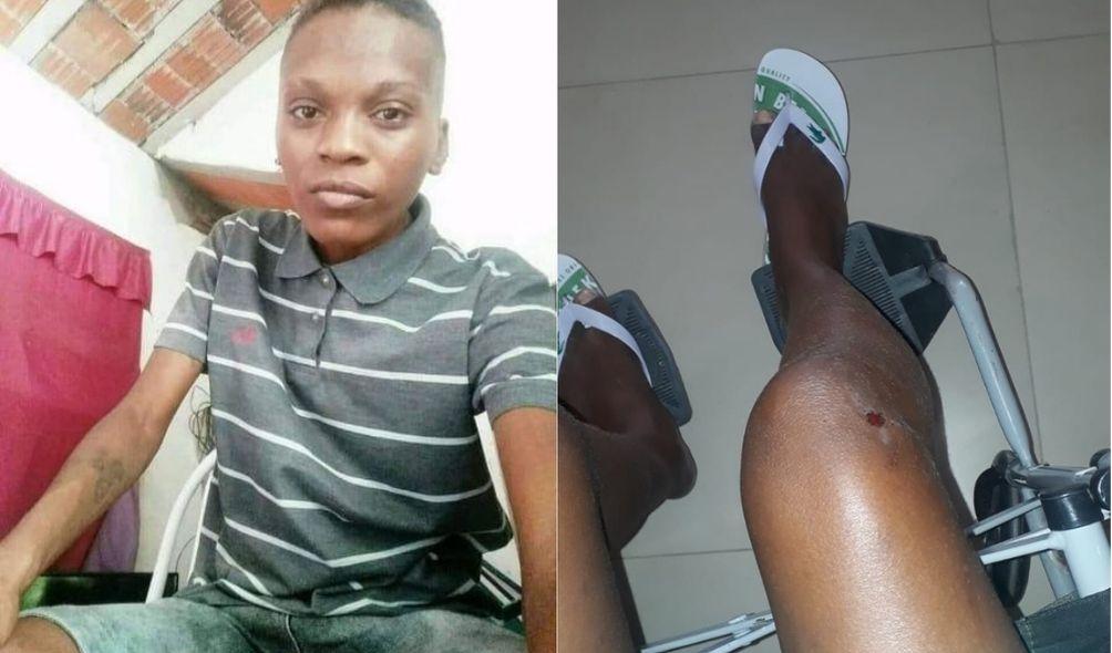 Montagem com fotos de mulher lésbica agredida (à esquerda) e joelho da vítima ferido (à direita)