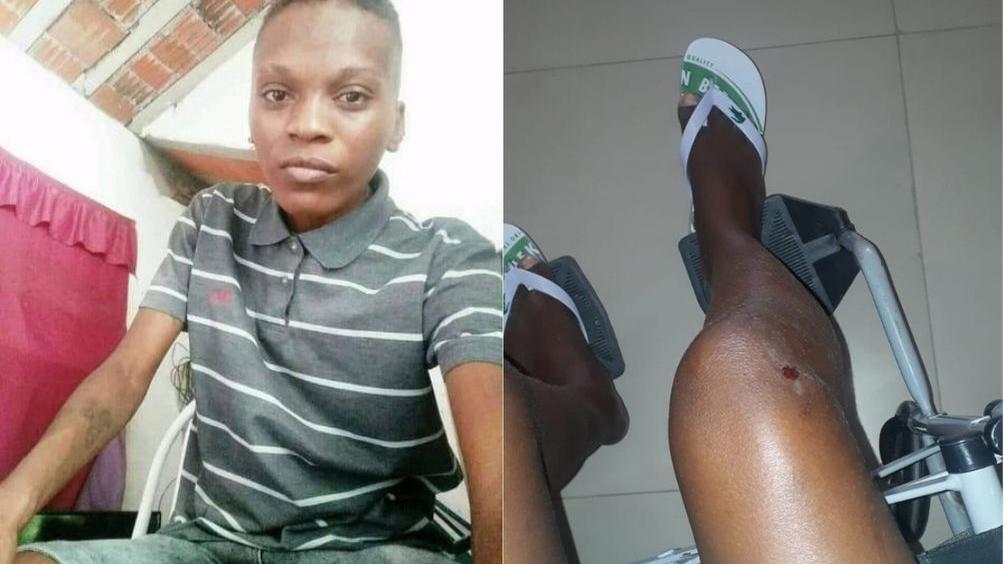 Montagem com fotos de mulher lésbica agredida (à esquerda) e joelho da vítima ferido (à direita)