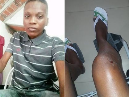 Montagem com fotos de mulher lésbica agredida (à esquerda) e joelho da vítima ferido (à direita)