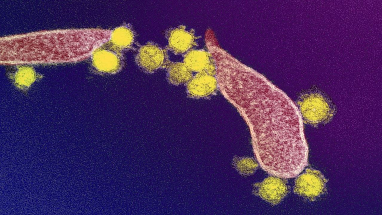 Célula humana (em rosa) sendo infectada pelo novo coronavírus (em amarelo)