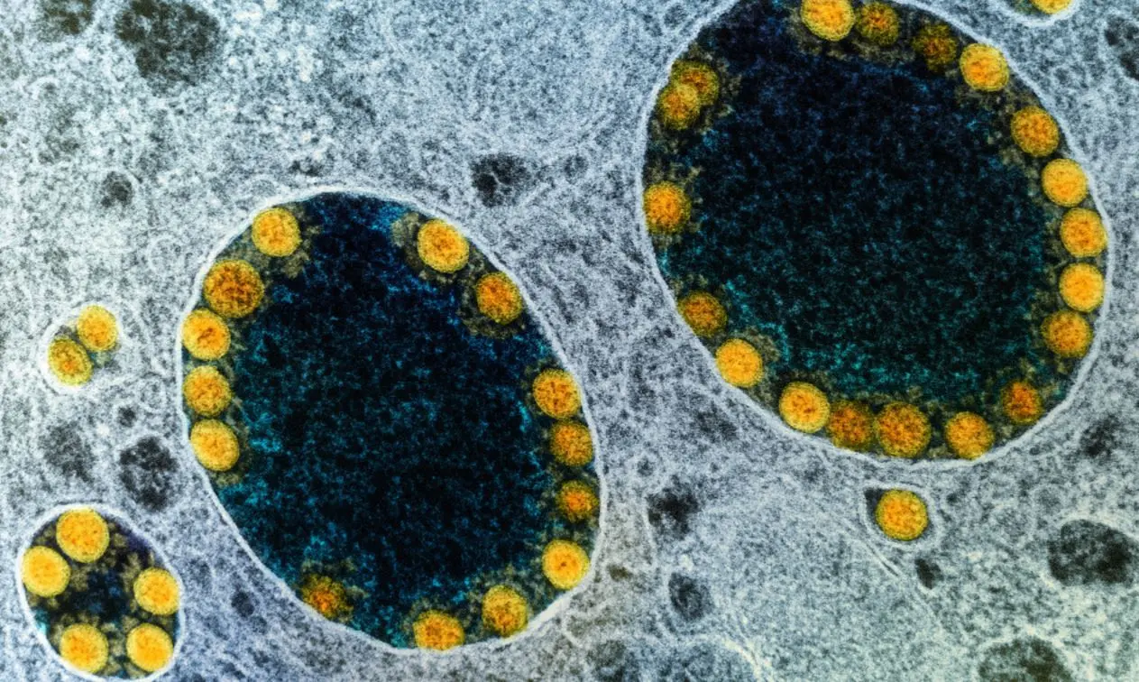 Coronavírus (em amarelo) infectando célula humana