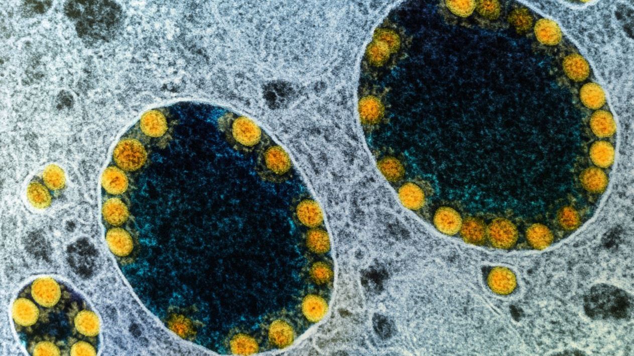 Coronavírus (em amarelo) infectando célula humana