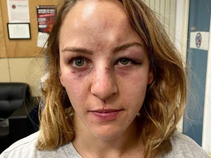 Judoca francesa Margaux Pinot apresenta ferimentos no rosto, como nariz, olhos, testa