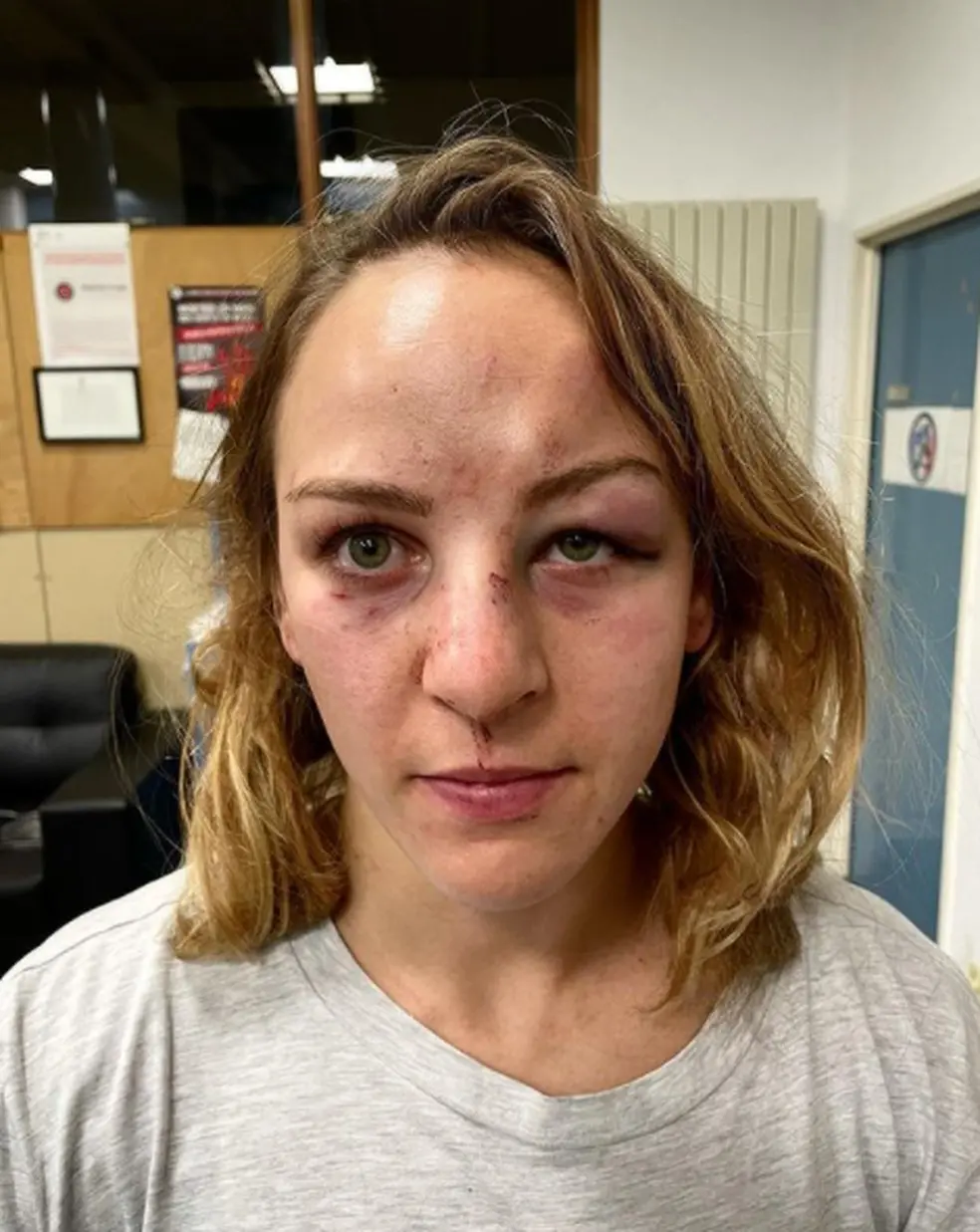 Judoca francesa Margaux Pinot apresenta ferimentos no rosto, como nariz, olhos, testa