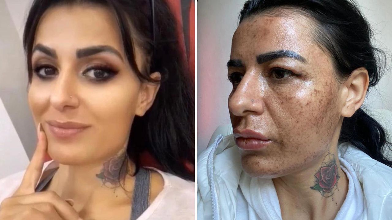 Montagem de antes e depois de turca que teve o rosto queimado após estaticista se distrair durante procedimento estético