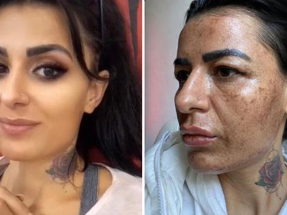 Montagem de antes e depois de turca que teve o rosto queimado após estaticista se distrair durante procedimento estético