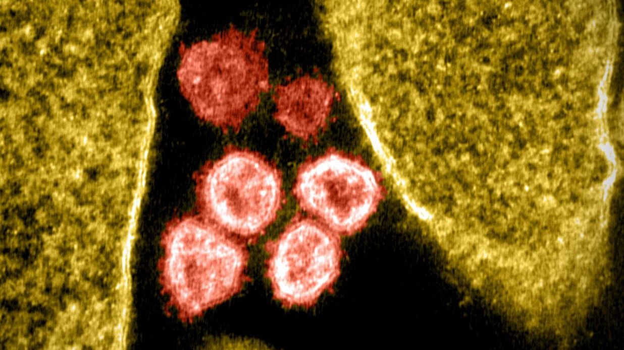 Imagem de coronavírus infectando célula vista por microscópio