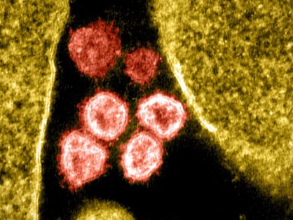 Imagem de coronavírus infectando célula vista por microscópio