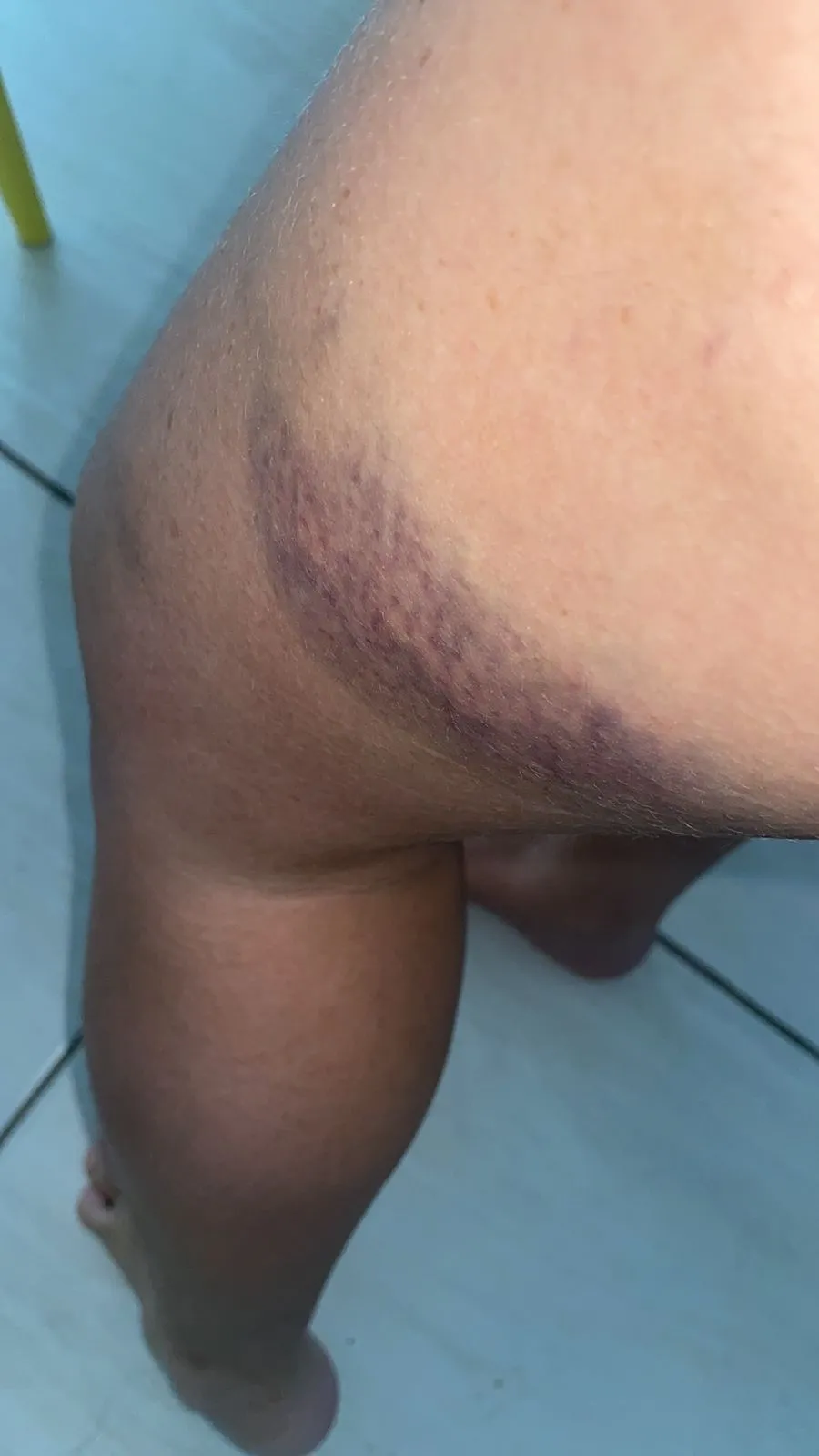Fernanda conta que ficou com hematomas por todo o corpo