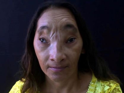 Maria Evangelista, cearense com deficiência de afundamento no rosto