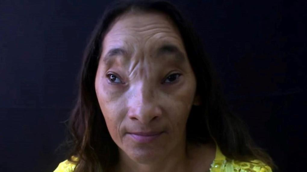 Maria Evangelista, cearense com deficiência de afundamento no rosto