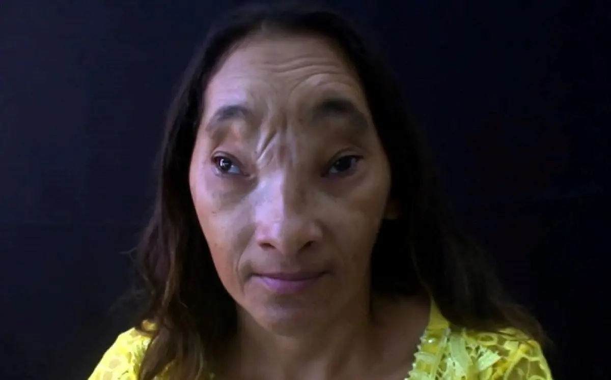 Maria Evangelista, cearense com deficiência de afundamento no rosto