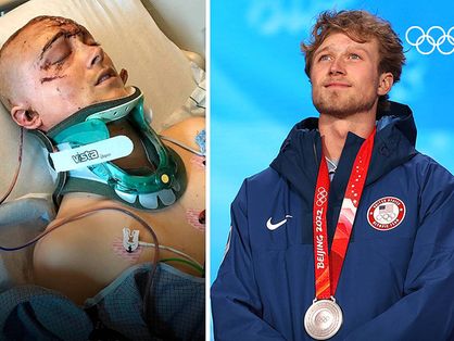 Esquiador americano Colby Stevenson aparece machucado na primeira foto, na segunda ele está com a medalha de prata conquistada nas Olimpíadas de Inverno