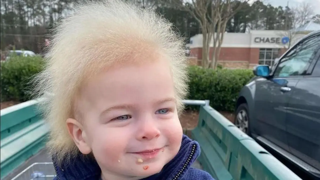 Menino com 'síndrome do cabelo impenteável'