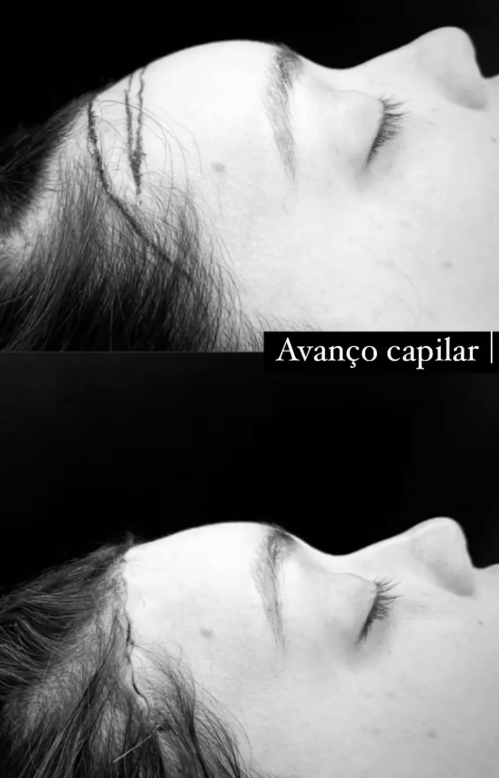 Antes e depois da cirurgia de avanço capilar de Thais Braz