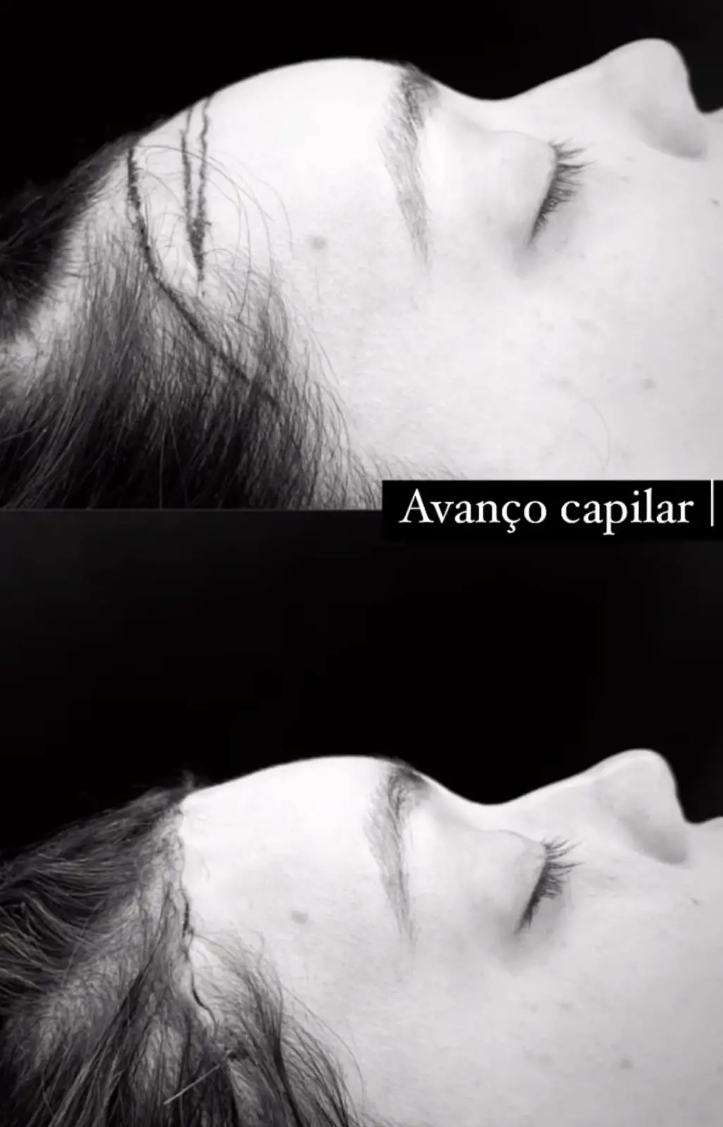 foto de antes e depois da cirurgia de avanço capilar de Thais Braz