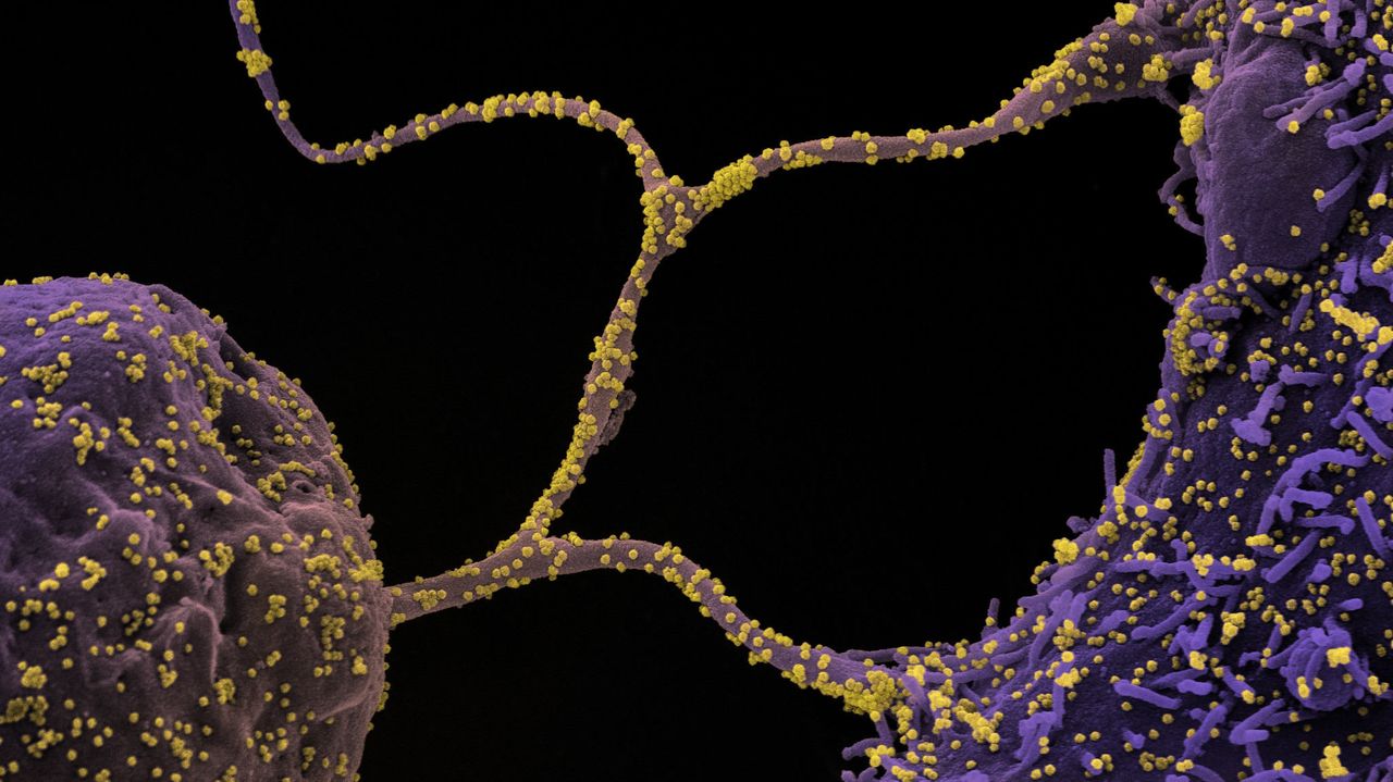 Micrografia eletrônica de varredura colorida de células CCL-81 (roxa) infectadas com partículas do vírus SARS-CoV-2 (amarelo), isoladas de uma amostra de paciente.