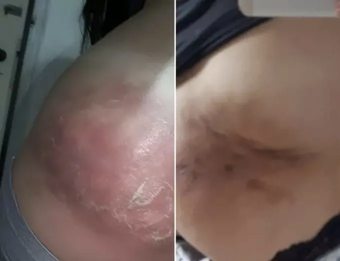 foto do bumbum com infecção após injeção