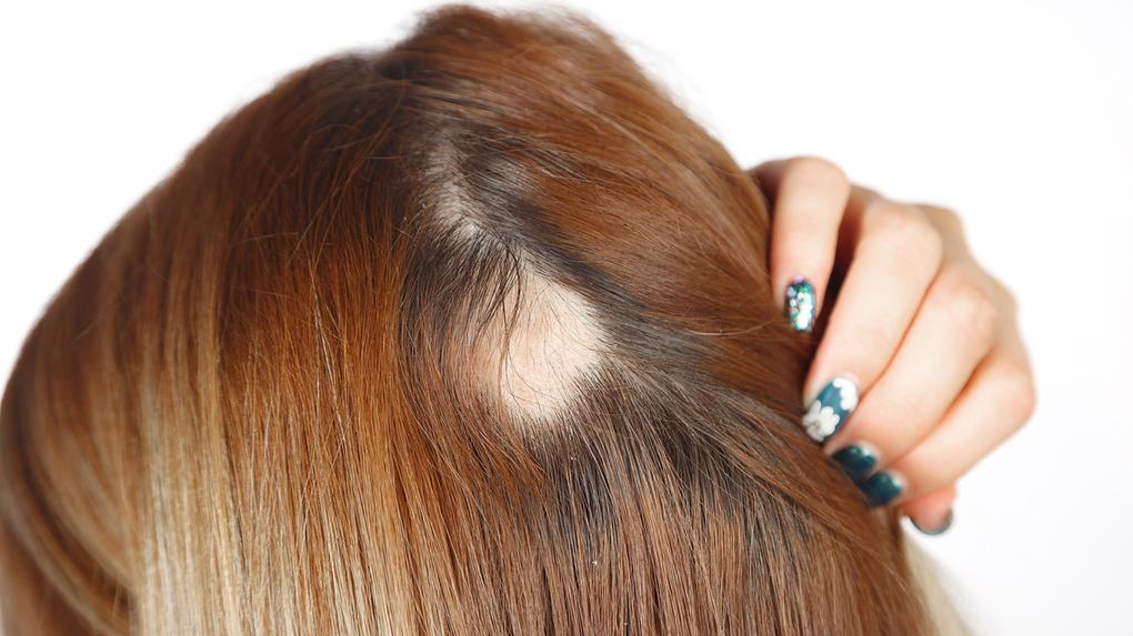 Estudos em saúde apontam pelo menos setes tipos recorrentes de alopecia
