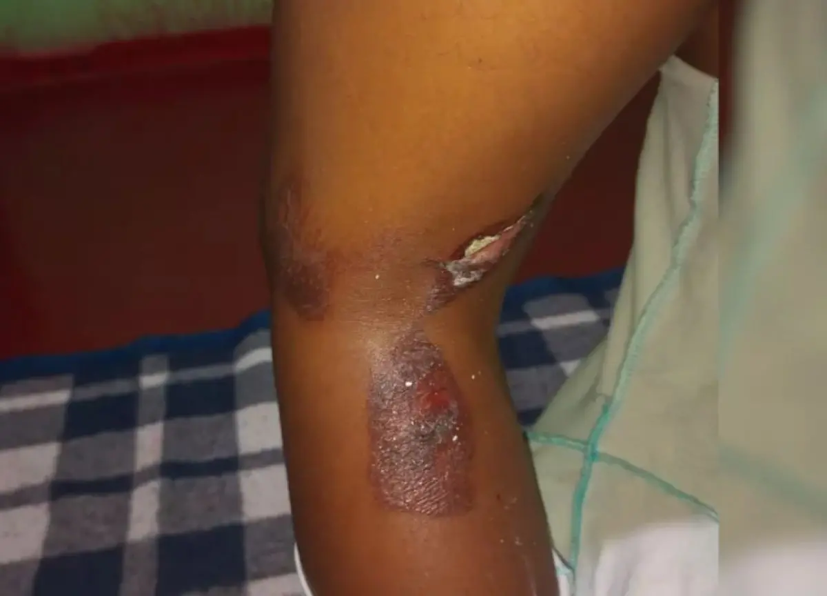 QUEIMADURAS NA PELE DE CRIANÇA